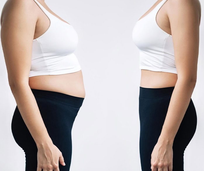 amazing results before and after mommy makeover surgery in Albania