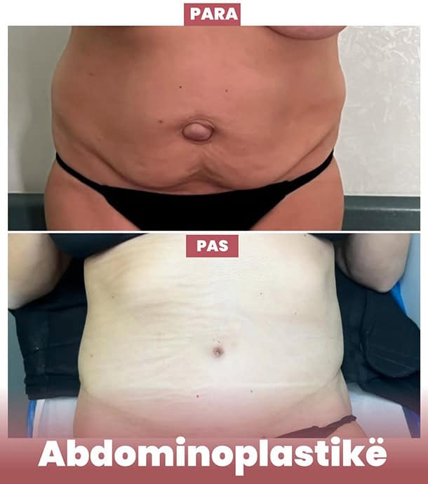 amazing results before and after tummy tuck in Albania