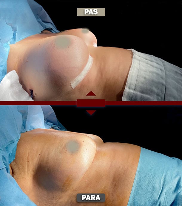 amazing transformation after breast augmentation in Albania