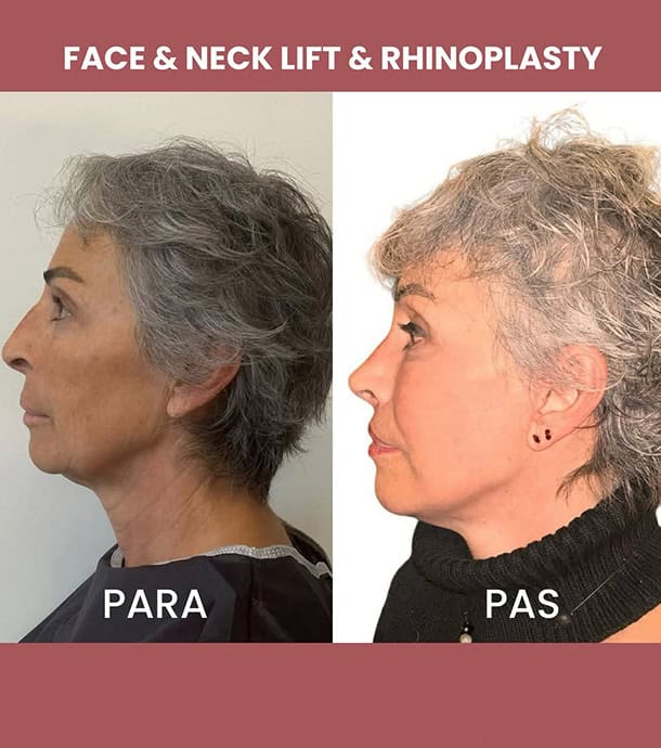 amazing transformation after face lift in Albania