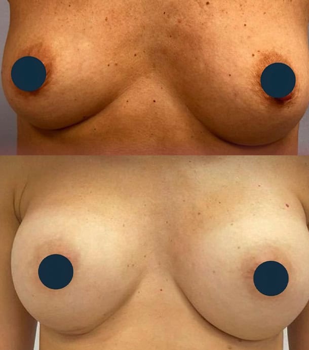 amazing transformation before and after breast augmentation in Albania