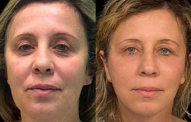 amazing results after face lift in Tirana