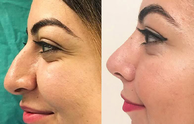 before and after nose surgery in Albania