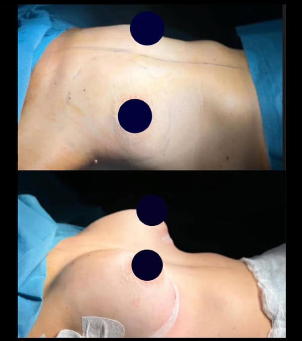 before and after breast augmentation in Albania