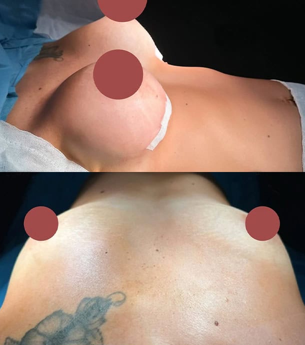 before and after breast enlargement in Albania