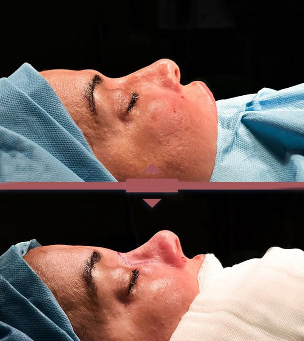 before and after nose surgery in Albania