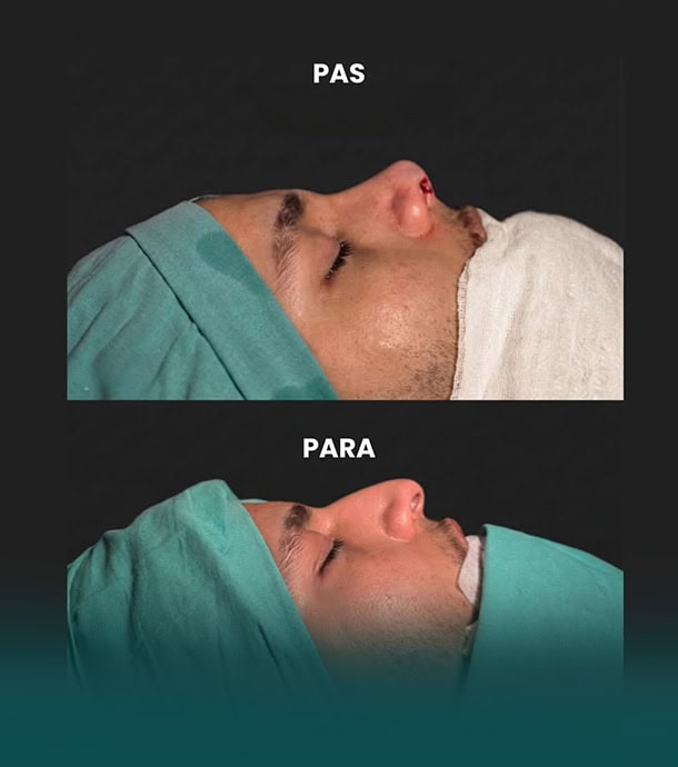 before and after results rhinoplasty in Albania