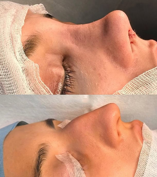 before and after rhinoplasty in Albania real patient case