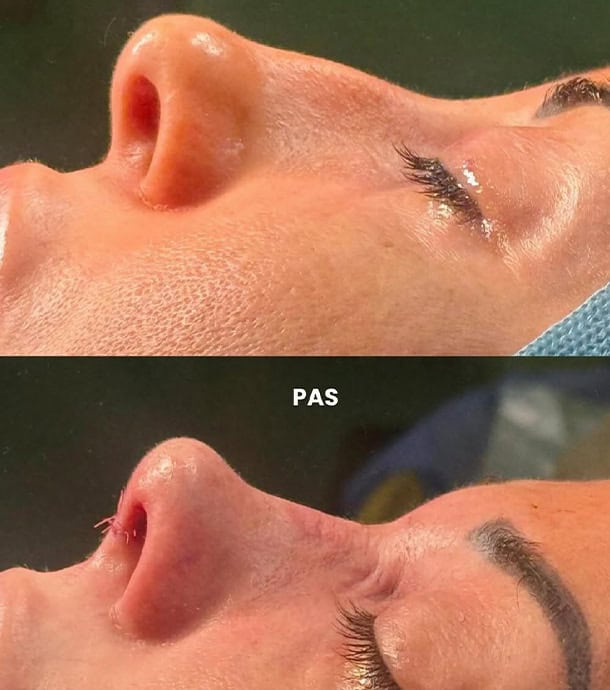 before and after rhinoplasty in Albania real patient results