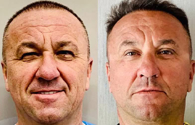 results before and after male face lift in Albania
