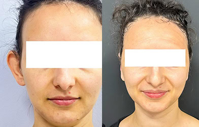 results before and after otoplasty in Albania