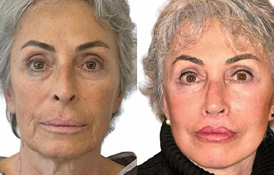 results before and after face lift in Albania