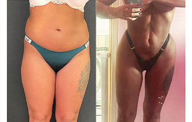 results before and after liposuction in Albania