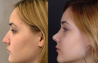 results before and after nose surgery in Albania