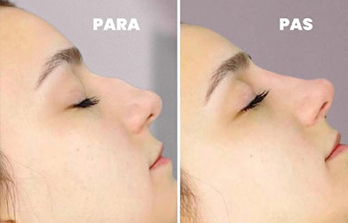 before and after nose surgery in Albania