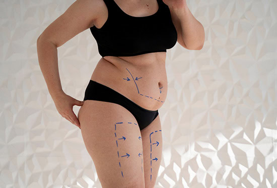 ideal candidates for liposuction in Albania