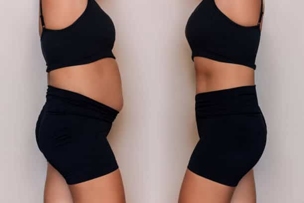 results before and after liposuction in Albania, stomach fat removal 