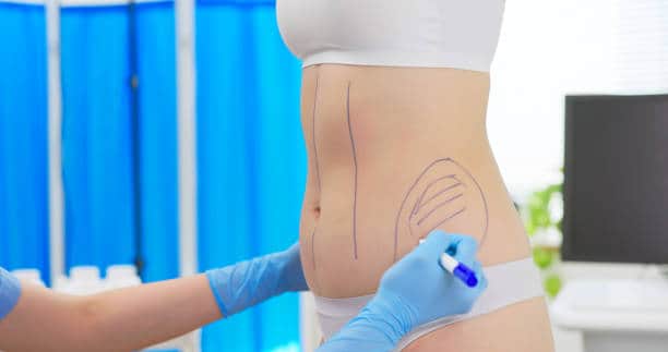 Pre-operative marking and surgical planning before liposuction in Albania