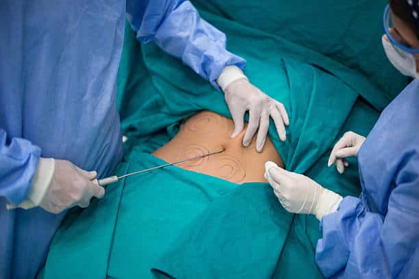 Cosmetic liposuction surgery in Albania