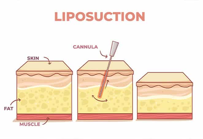 liposuction in Albania, procedure explained