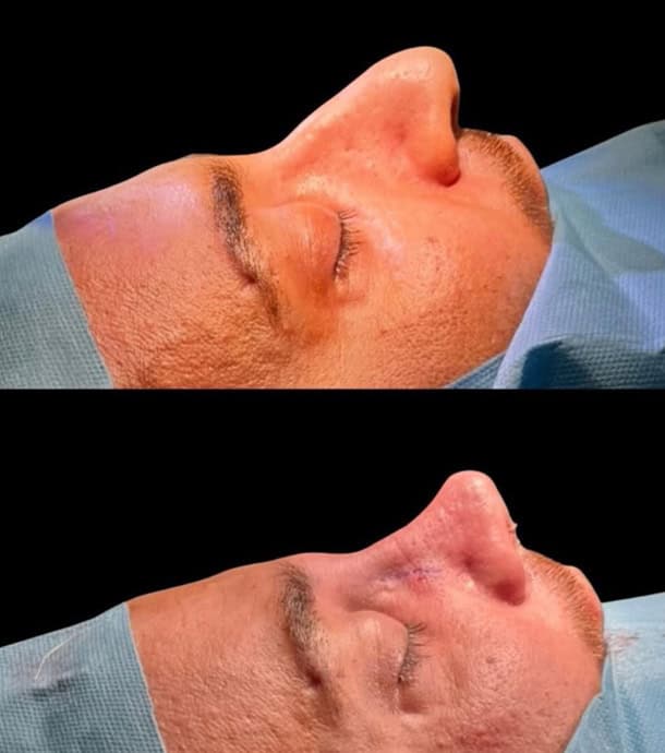 male rhinoplasty in Albania before and after results