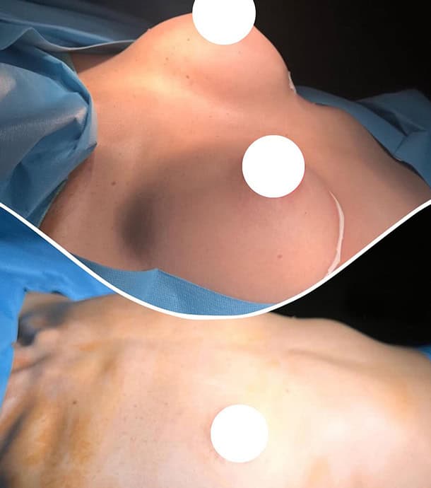 real patient results before and after breast implants in Albania