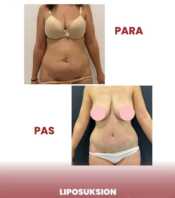 real patient results before and after liposuction in Albania
