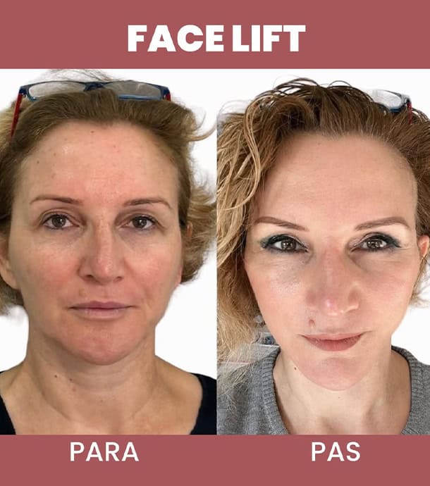 real patient transformation after face lift in Albania