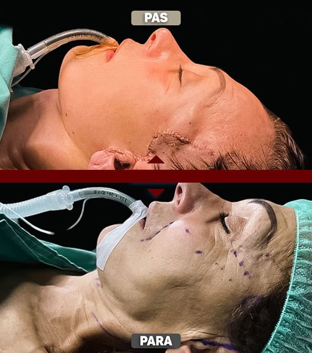 real patient transformation after face lift surgery in Albania