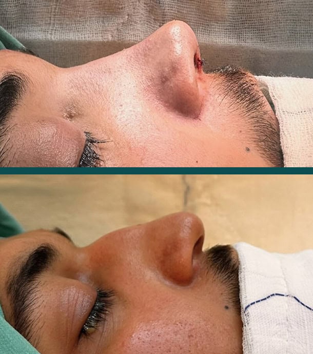 results after male rhinoplasty in Albania