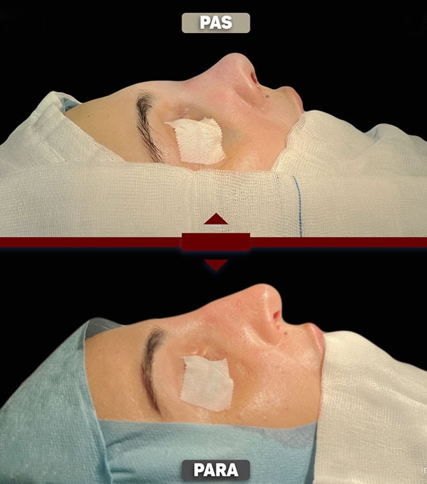 results after rhinoplasty in Albania