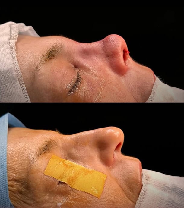 rhinoplasty in Albania at affordable prices