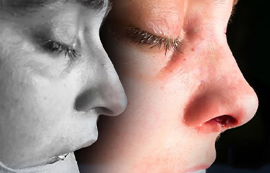 before and after rhinoplasty in Albania