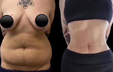 results before and after mommy makeover in Albania