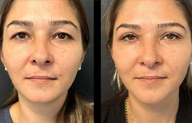 amazing results before and after blepharoplasty in Albania
