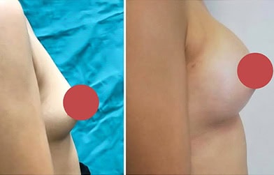 amazing results before and after breast enlargement in Albania