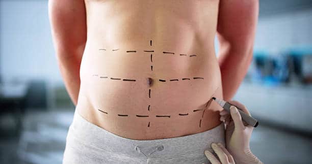 Abdominoplasty For Men In Albania markup at belly