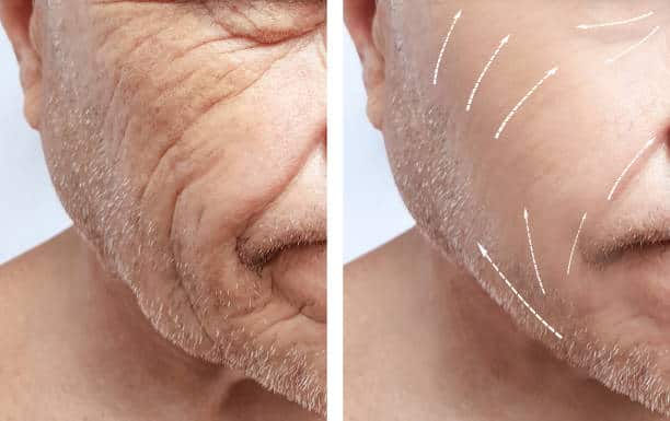 Facelift for men in Albania