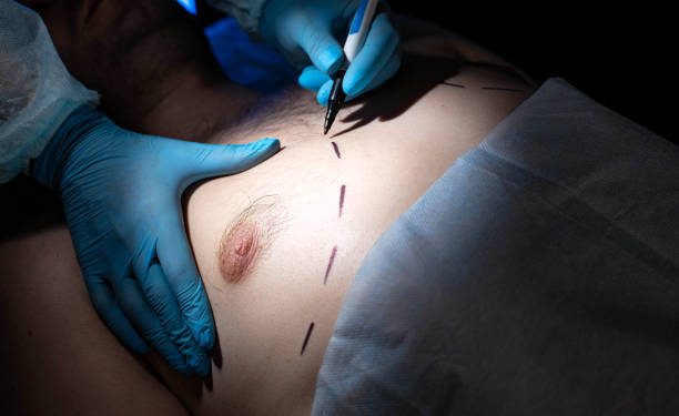 gynecomastia surgery in Albania