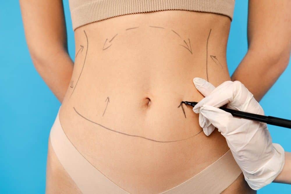 abdominoplasty in Albania