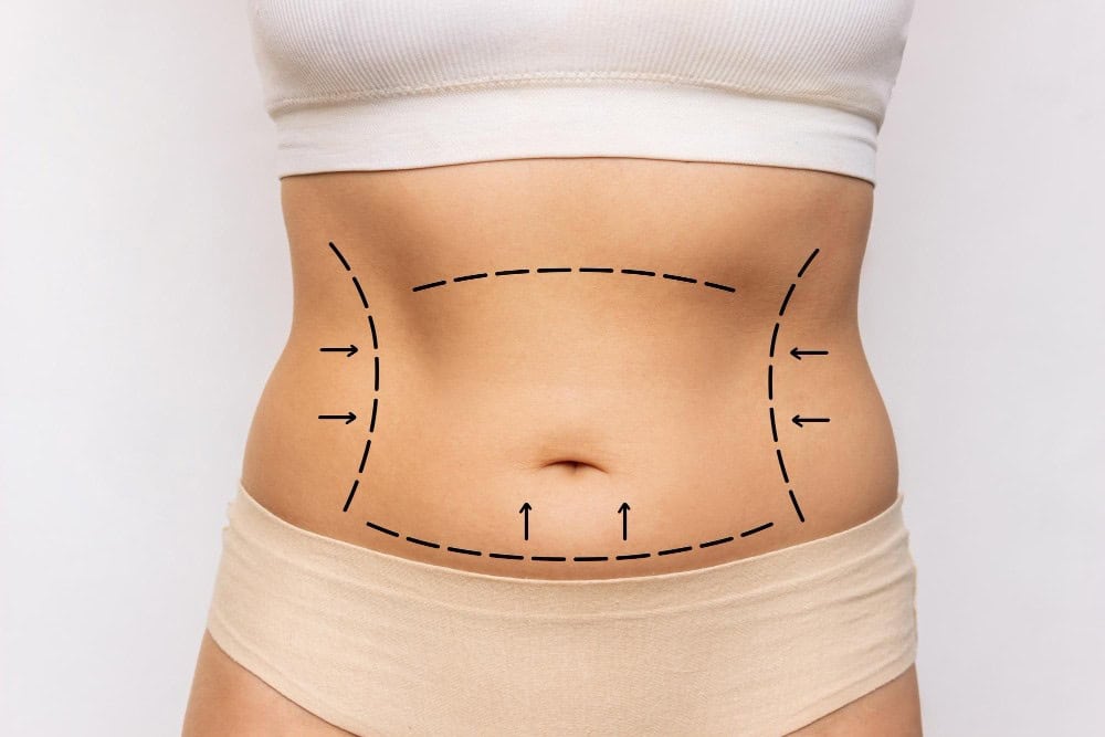 Pre-surgery markings on abdomen for liposuction in Albania