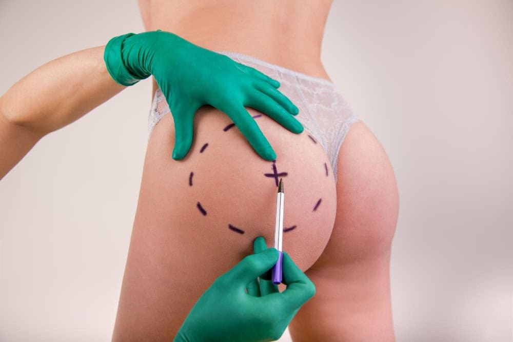 Pre-surgery markings for Brazilian Butt Lift in Albania