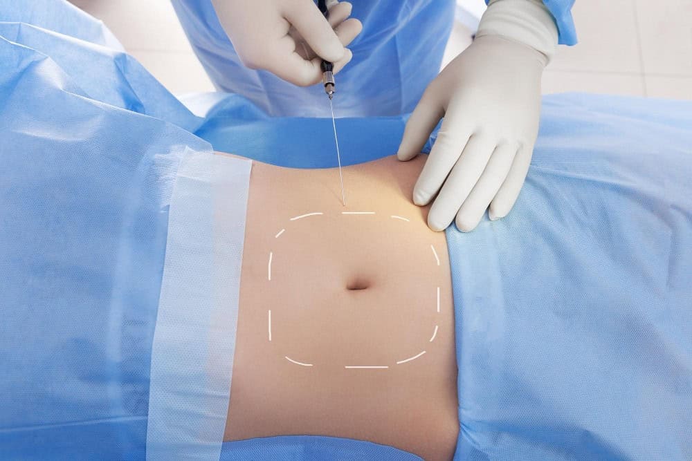 Doctor performing liposuction in Albania