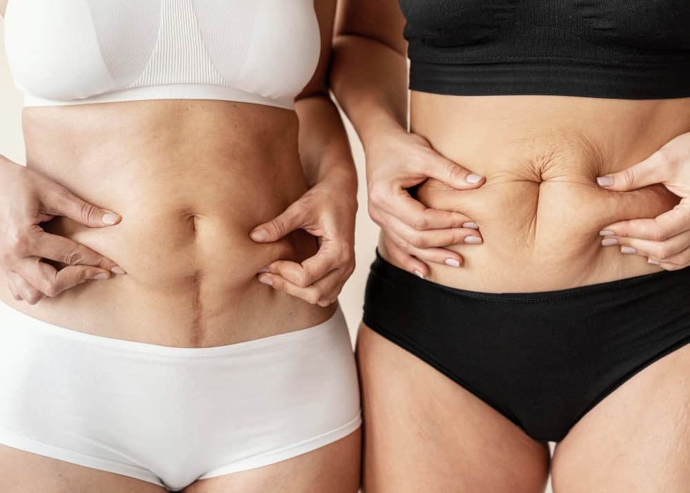 “Close-up of abdomen with loose skin and fat, a common concern treated with a mommy makeover in Albania