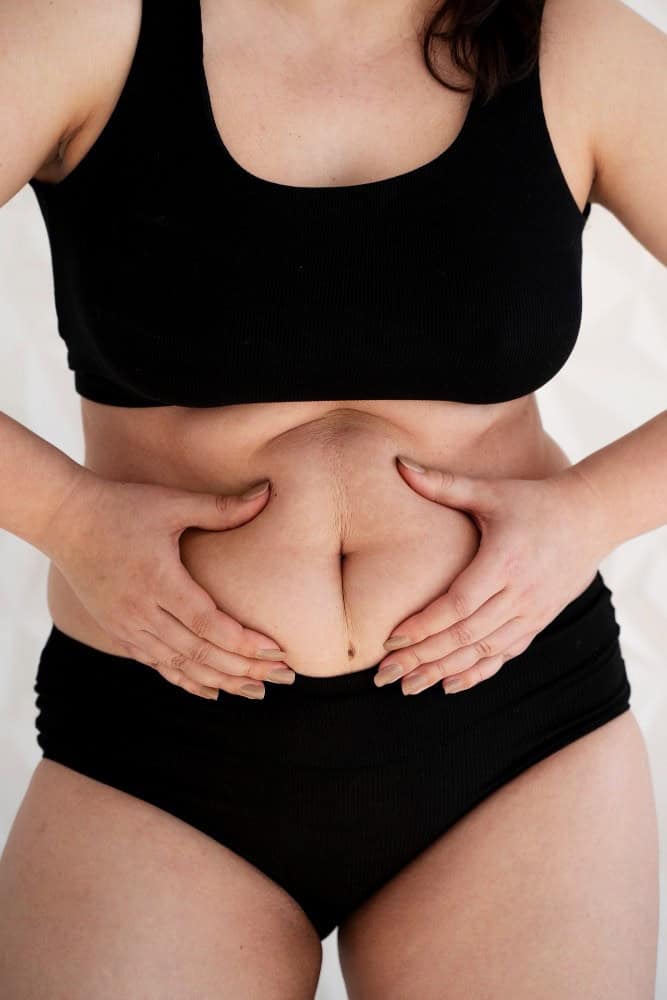 Woman holding excess skin after pregnancy, illustrating body changes before a mommy makeover in Albania