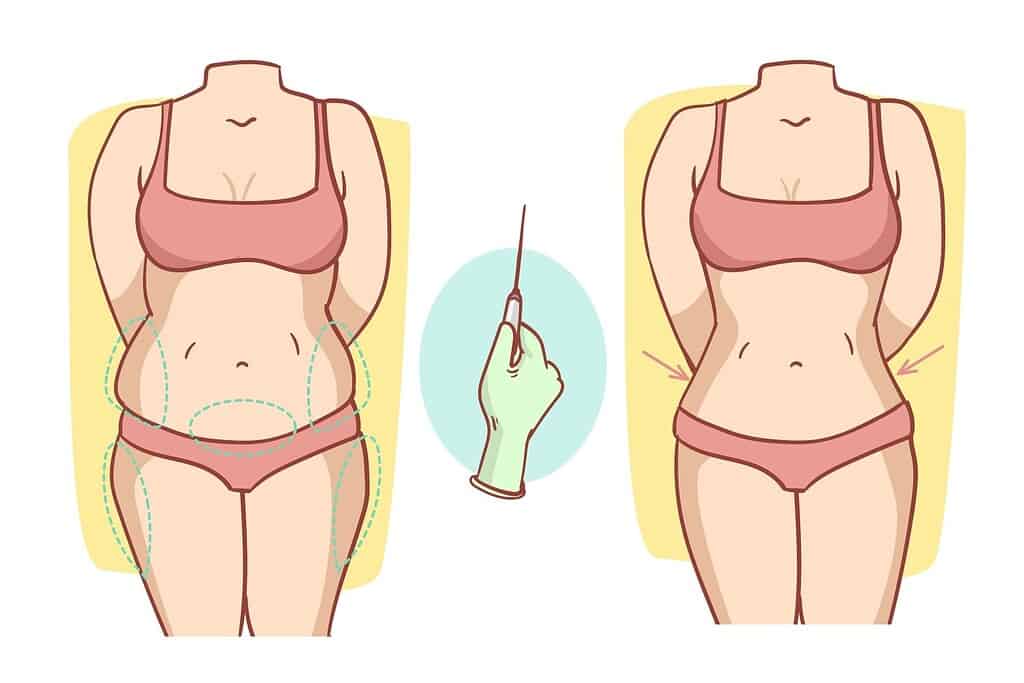 Medical visualization of liposuction in Albania showing fat removal process