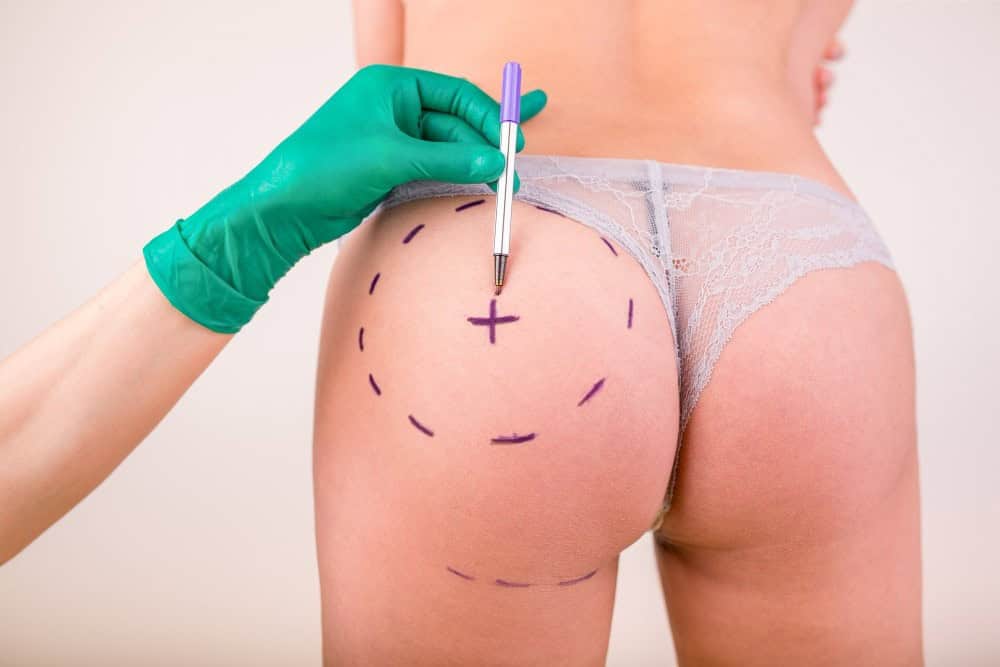 Close-up of body contour mapping for BBL in Albania