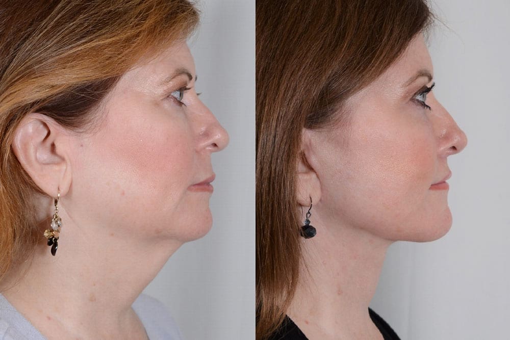 Before and after facial cosmetic surgery in Albania, profile view of woman.