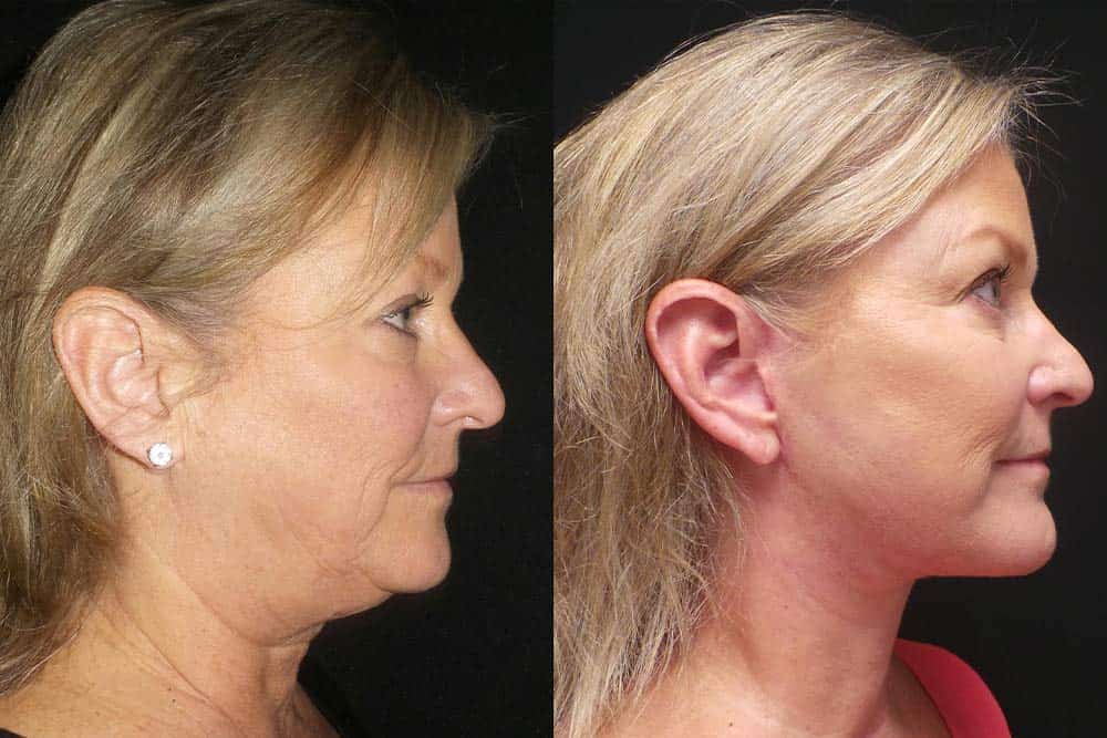 Before and after facelift showing improved jawline and neck contour.