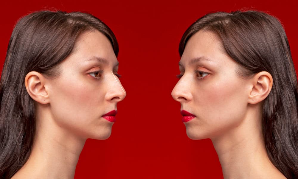 Side profile of woman showing nose correction results after surgery.